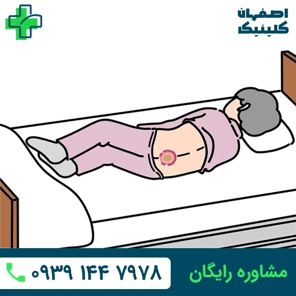 درمان زخم بستر در اصفهان