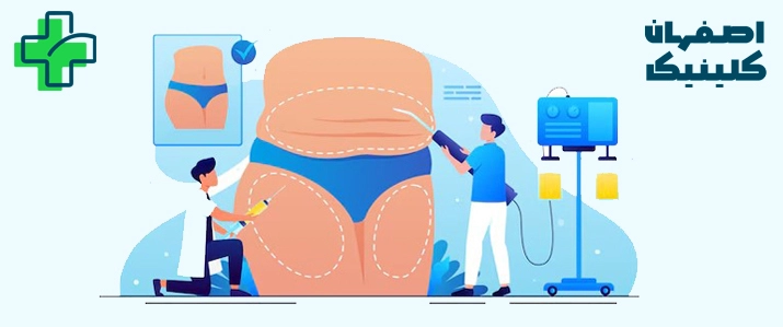 لیپوماتیک در اصفهان با بهترین جراح لیپوماتیک در اصفهان متد 2025